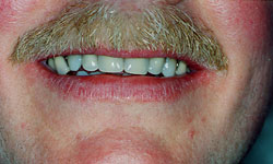 Denture and Implant Dentist Sutton - After Iamge 1