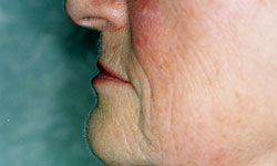 Denture and Implant Dentist Sutton - After Image 10