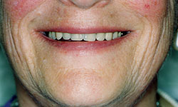 Denture and Implant Dentist Sutton - After image 2