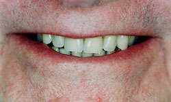 Denture and Implant Dentist Sutton - After Image 4