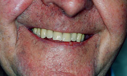 Denture and Implant Dentist Sutton - After Image 5