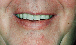 Denture and Implant Dentist Sutton - After Image 6