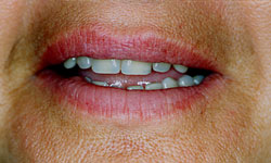 Denture and Implant Dentist Sutton - After Image 7