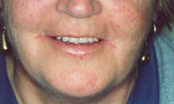 Denture and Implant Dentist Sutton - After Image 8
