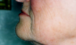 Denture and Implant Dentist Sutton - Before Image 10