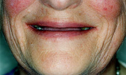 Denture and Implant Dentist Sutton - Before Image 2