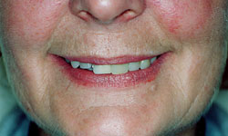 Denture and Implant Dentist Sutton - Before image 3