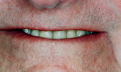 Denture and Implant Dentist Sutton - Before Image 4