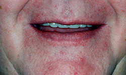 Denture and Implant Dentist Sutton - Before Image 6