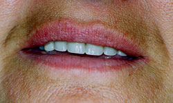 Denture and Implant Dentist Sutton - Before Image 7