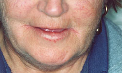Denture and Implant Dentist Sutton - Before Image 8