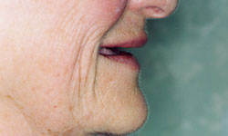 Denture and Implant Dentist Sutton - Before Image 9