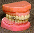 conventionally designed partial denture