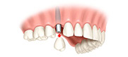 Denture and Implant Dentist Carshalton Beeches, Dental Implants Carshalton Beeches, Complete Dentures Surrey, Carshalton Beeches Denture and Implant Dentist