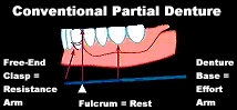 conventional partial denture