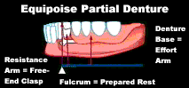 equipoise partial denture