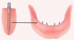 What are Mini Implants?