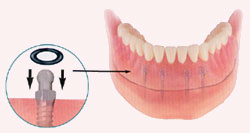 How are Mini Implants placed?
