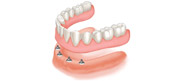 Denture and Implant Dentist Carshalton Beeches, Dental Implants Carshalton Beeches, Complete Dentures Surrey, Carshalton Beeches Denture and Implant Dentist