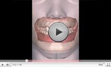 3D Dentures