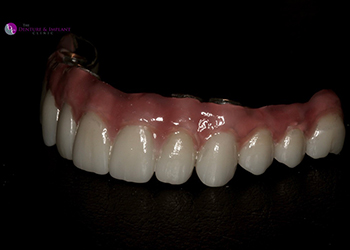 Same Day Teeth Images 012 of The Denture & Implant Clinic