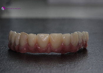 Same Day Teeth Images 033 of The Denture & Implant Clinic