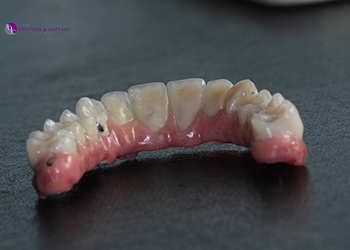 Same Day Teeth Images 034 of The Denture & Implant Clinic
