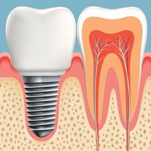 Versatile Dental Implants For Patients