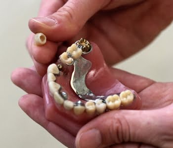 Dentist in Carshalton Beeches offers chrome and metal frame dentures