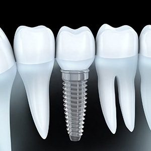 implant dentistry sutton