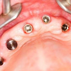 multiple implants epsom