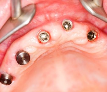 multiple implants epsom multiple implants epsom