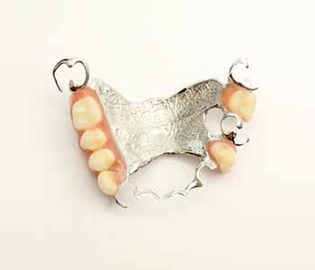 The Difference In Acrylic (Plastic) Vs. Metal (Cobalt Chrome) Dentures