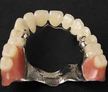 The Difference In Acrylic (Plastic) Vs. Metal (Cobalt Chrome) Dentures