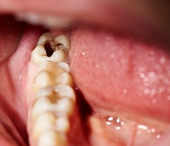 tooth decay causes sutton
