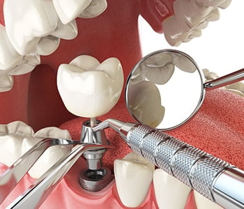 How long does it take for a dental implant to heal?