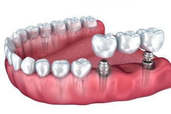 implant dentistry surrey