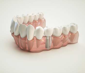 dental implants
