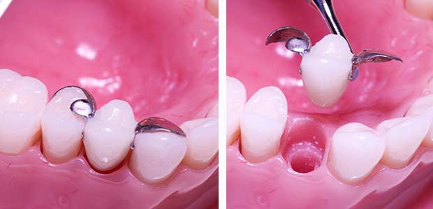 Replace a missing tooth - temporary tooth replacement you make