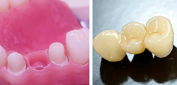 Options For Replacing A Single Missing Tooth