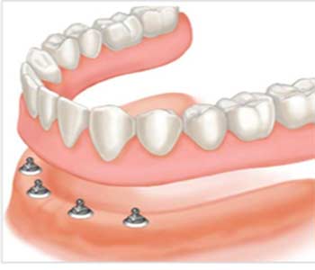 Implant Retained Dentures Implant Retained Dentures