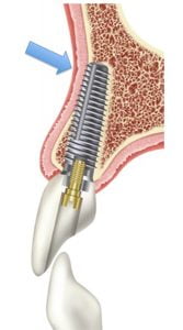 What Is The Southern Dental Implant System And Why Do We Use It At Our Practice?