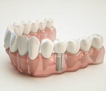 Dental implants keep your mouth healthy after teeth loss