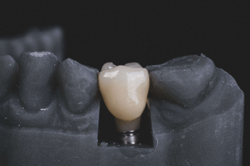 The Denture Implant Clinic Myths surrounding dental implants