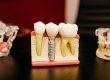 dental implant