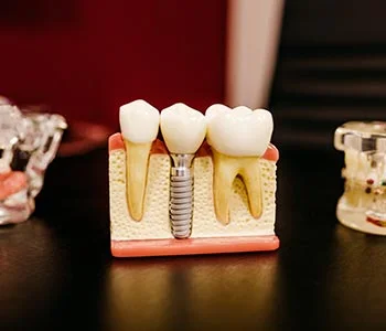 dental implant dental implant