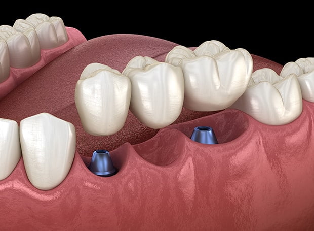 dental-implants-to-replace-several-missing-teeth