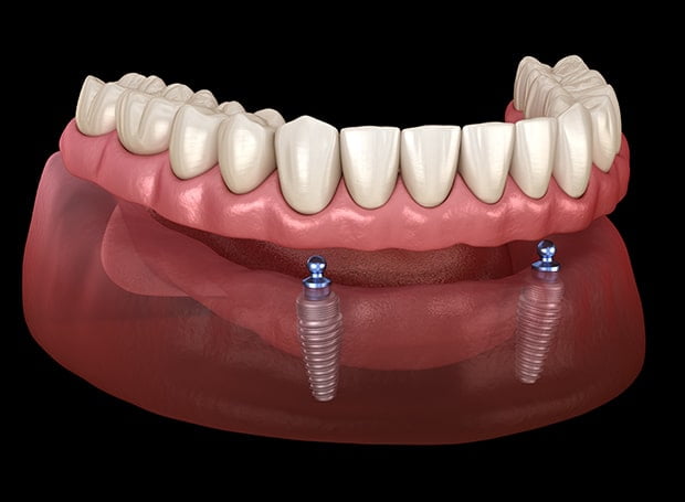 implant-detained-dentures-to-held-anchor