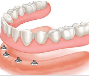 full-dentures