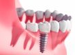 The lifespan of teeth implants